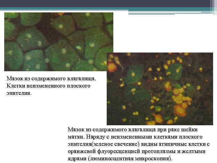 Мазок из содержимого влагалища. Клетки неизмененного плоского эпителия. Мазок из содержимого влагалища при раке