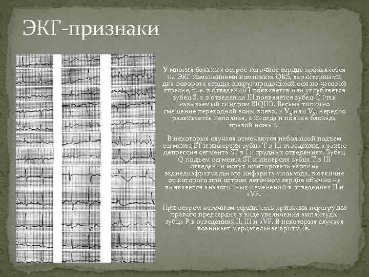 ЭКГ-признаки У многих больных острое легочное сердце проявляется на ЭКГ изменениями комплекса QRS, характерными