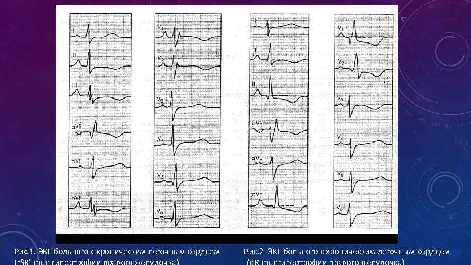 Рис. 1. ЭКГ больного с хроническим легочным сердцем (r. SR'-mun гипертрофии правого желудочка) Рис.