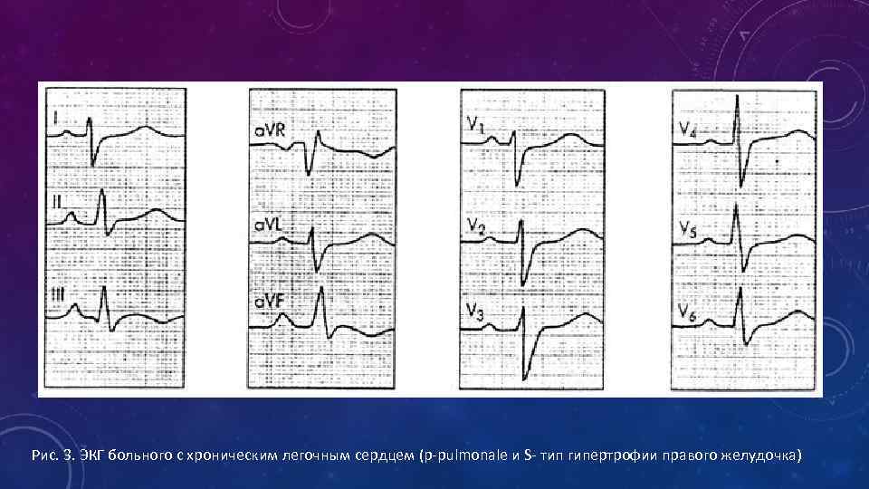 Рис. 3. ЭКГ больного с хроническим легочным сердцем (p-pulmonale и S- тип гипертрофии правого