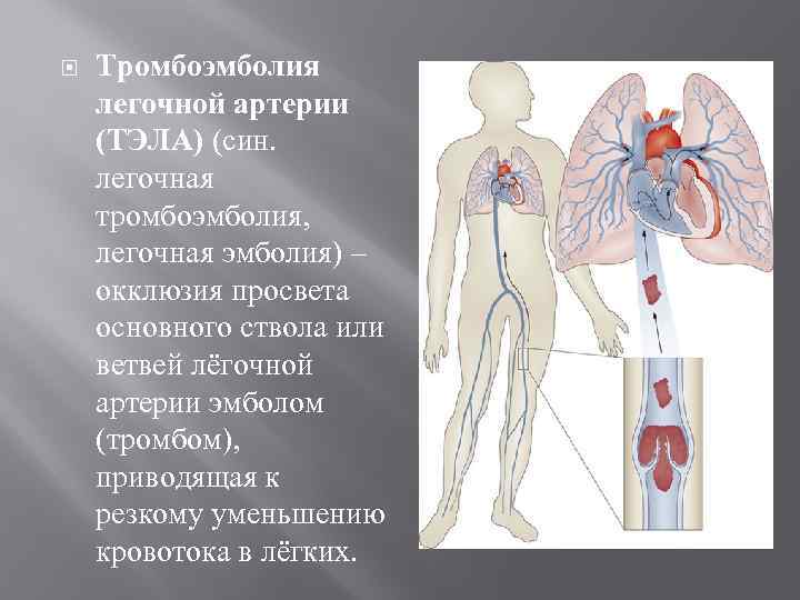 Что такое легочная тромбоэмболия простыми словами. Тромбоэмболия легочной артерии. Источник эмболии легочной артерии.