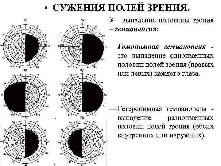  • СУЖЕНИЯ ПОЛЕЙ ЗРЕНИЯ. Ø выпадение половины зрения – гемианопсия: — Гомонимная гемианопсия