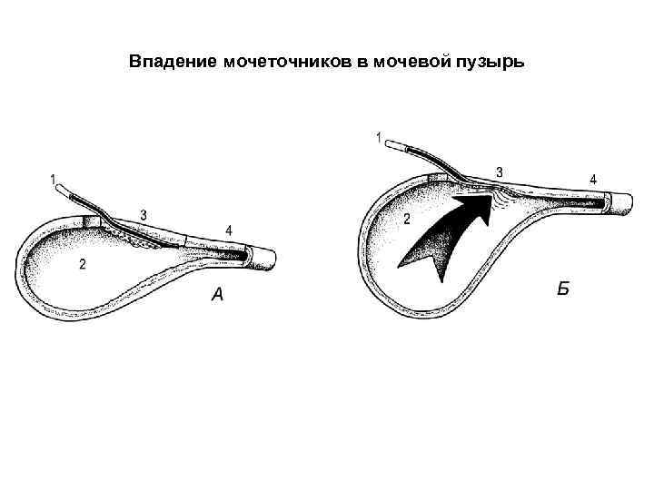 Впадение мочеточников в мочевой пузырь 