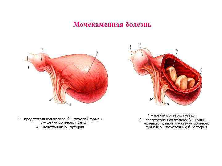 Мочекаменная болезнь 1 – предстательная железа; 2 – мочевой пузырь; 3 – шейка мочевого