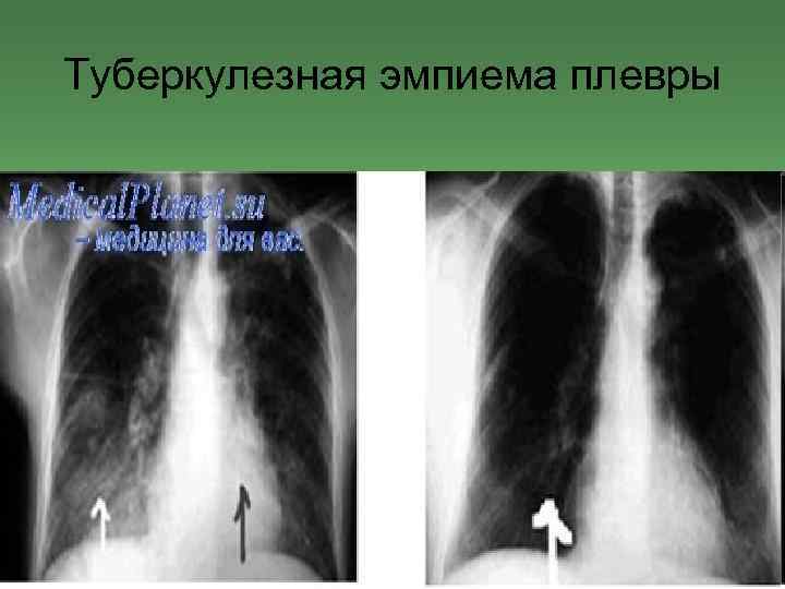 Туберкулезная эмпиема плевры 