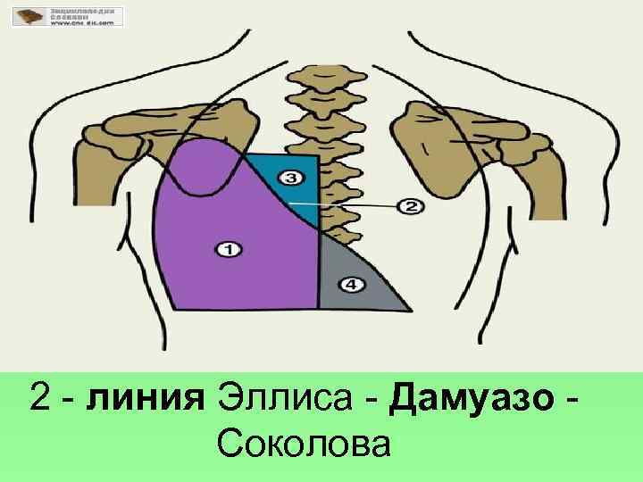 2 - линия Эллиса - Дамуазо - Соколова 