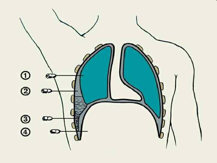 Плевральная пункция 