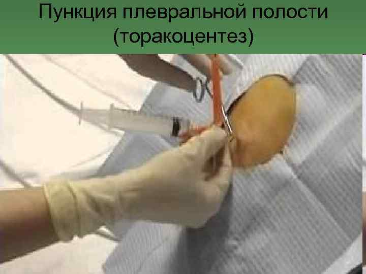 Пункция плевральной полости (торакоцентез) 