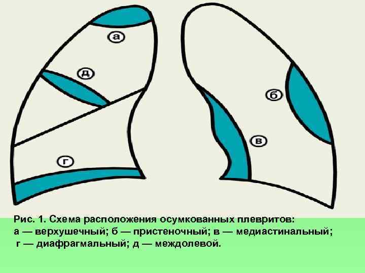 Рис. 1. Схема расположения осумкованных плевритов: а — верхушечный; б — пристеночный; в —