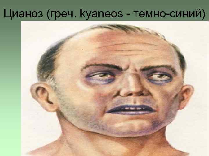 Цианоз (греч. kyaneos - темно-синий) 