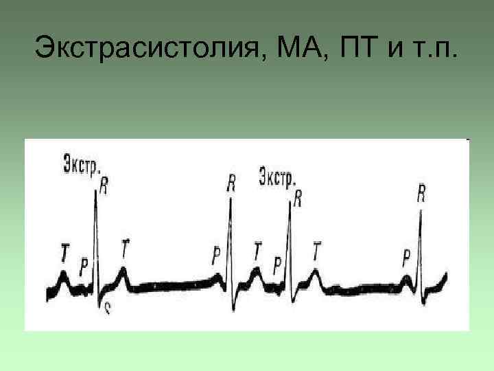 Экстрасистолия, МА, ПТ и т. п. 