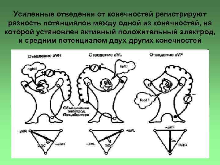 Усиленные отведения от конечностей регистрируют разность потенциалов между одной из конечностей, на которой установлен