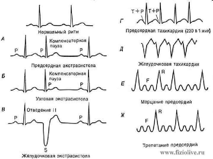 Нарушение ритма сердца карта вызова