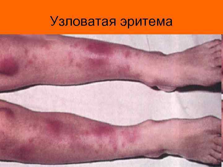 Узловатая эритема 