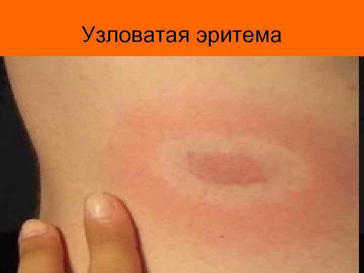 Узловатая эритема 