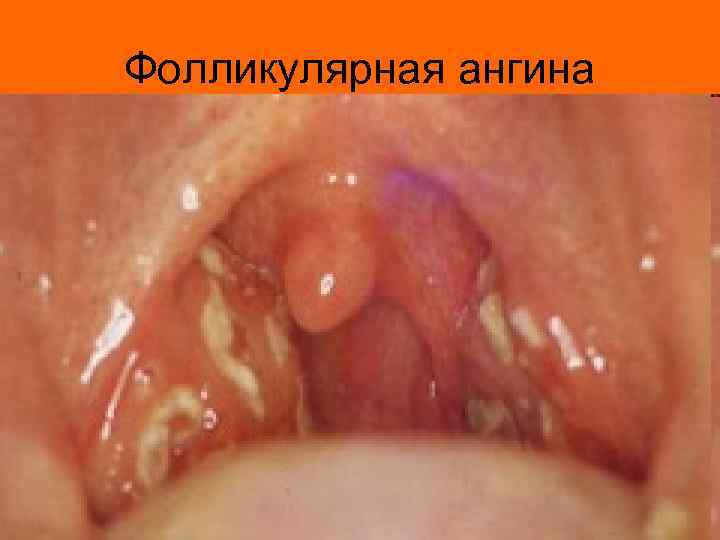 Фолликулярная ангина 