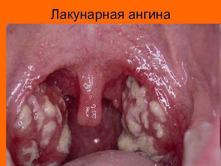 Лакунарная ангина 