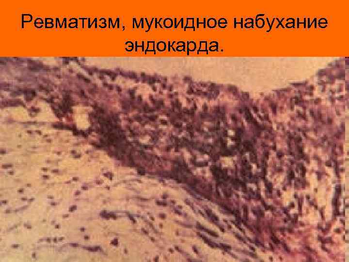 Ревматизм, мукоидное набухание эндокарда. 