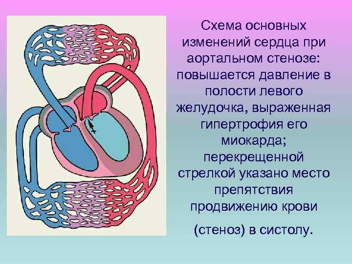 Схема основных изменений сердца при аортальном стенозе: повышается давление в полости левого желудочка, выраженная