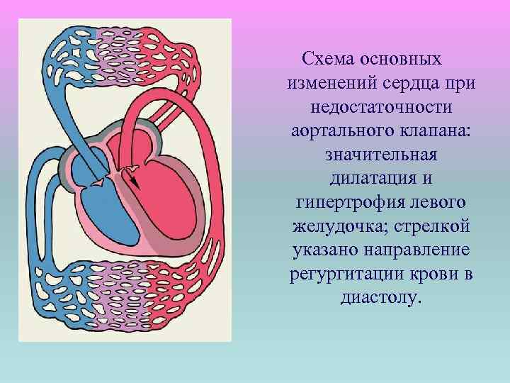 Схема основных изменений сердца при недостаточности аортального клапана: значительная дилатация и гипертрофия левого желудочка;