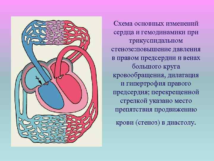 Схема основных изменений сердца и гемодинамики при трикуспидальном стенозе: повышение давления в правом предсердии