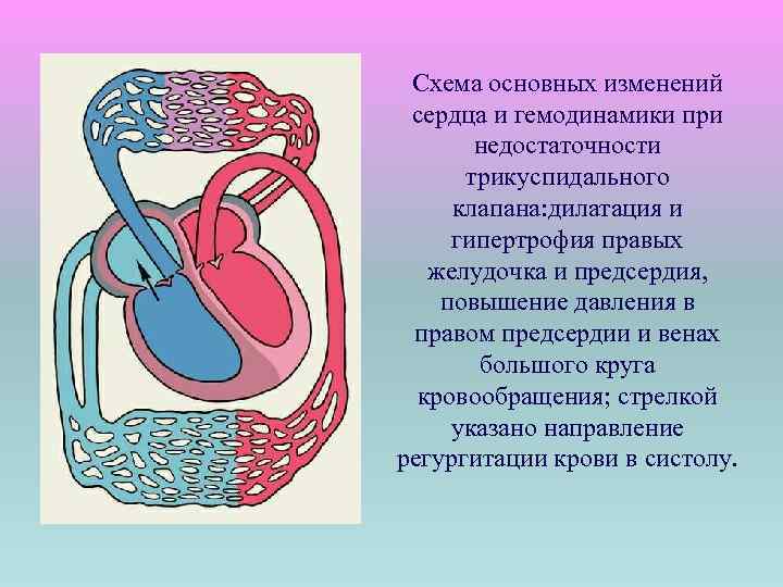 Схема основных изменений сердца и гемодинамики при недостаточности трикуспидального клапана: дилатация и гипертрофия правых