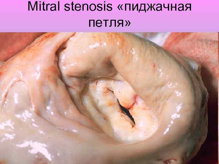 Mitral stenosis «пиджачная петля» 