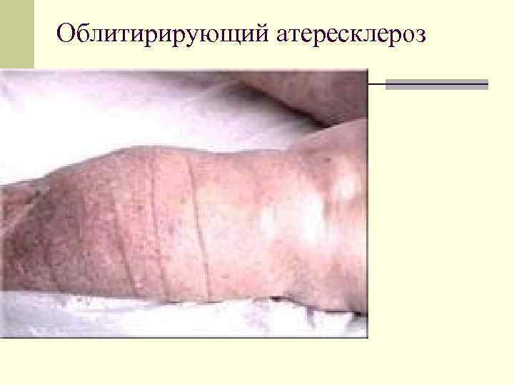 Облитирирующий атересклероз 