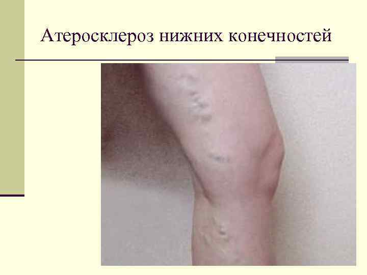 Атеросклероз нижних конечностей 