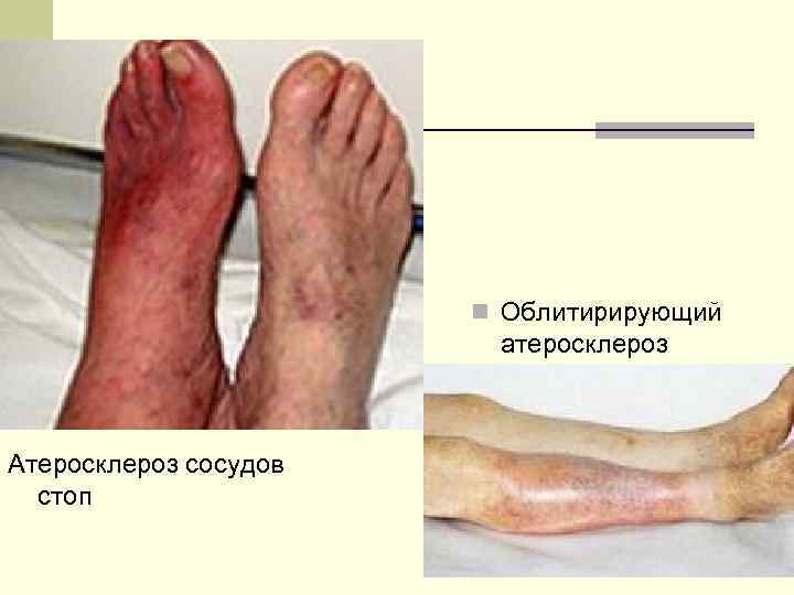n Облитирирующий атеросклероз Атеросклероз сосудов стоп 