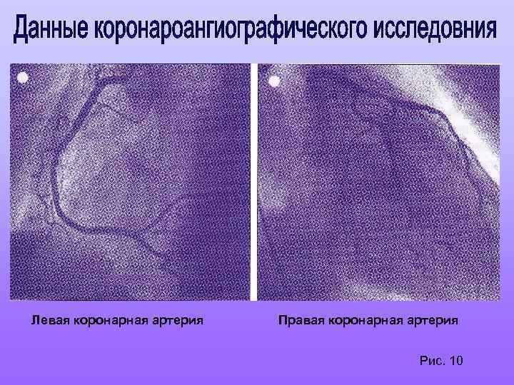 Левая коронарная артерия Правая коронарная артерия Рис. 10 