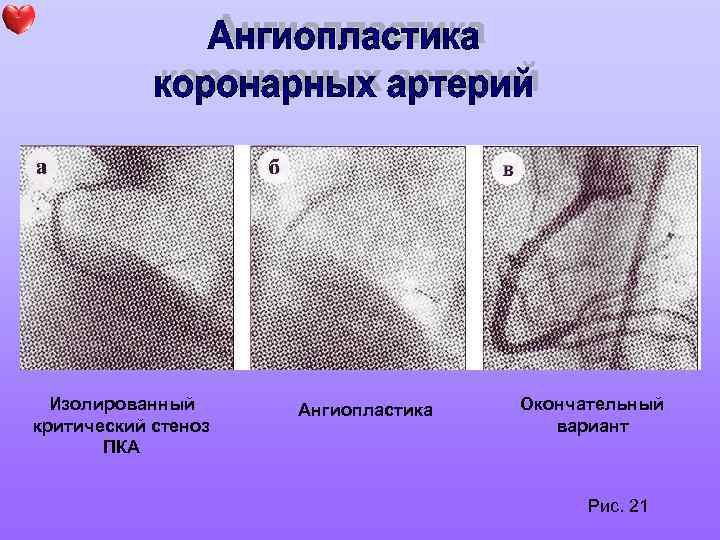 Ибс нестабильная стенокардия карта вызова