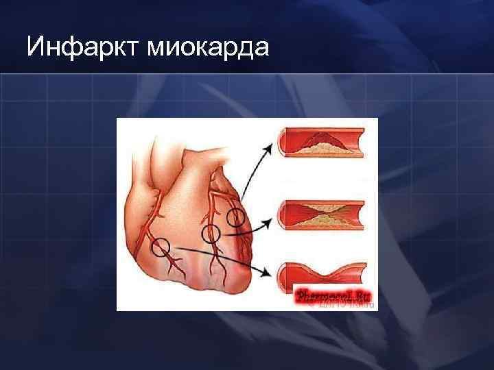 Инфаркт миокарда 