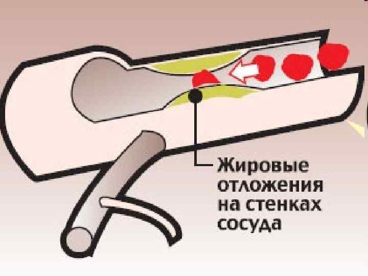 Сп при инфаркте миокарда