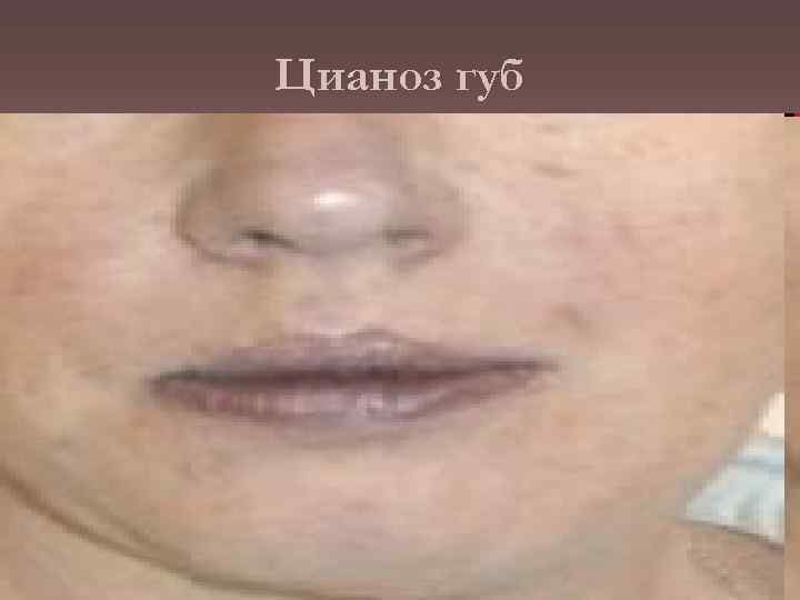 Цианоз губ 