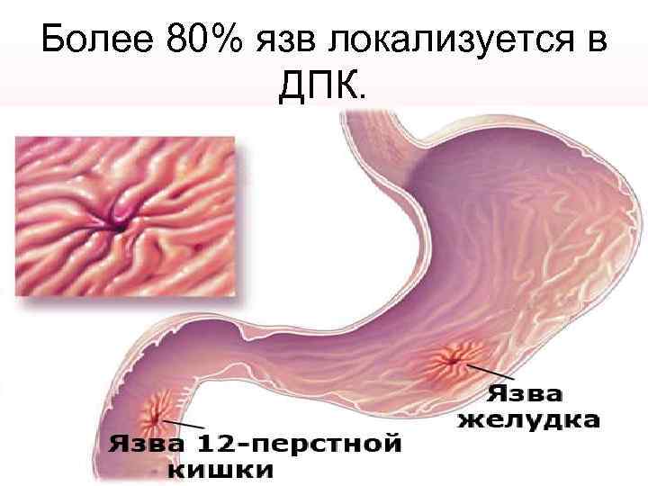 Более 80% язв локализуется в ДПК. 