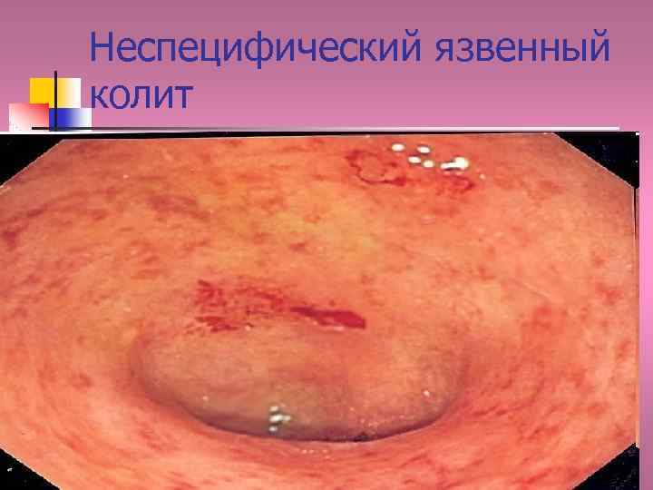 Неспецифический язвенный колит 