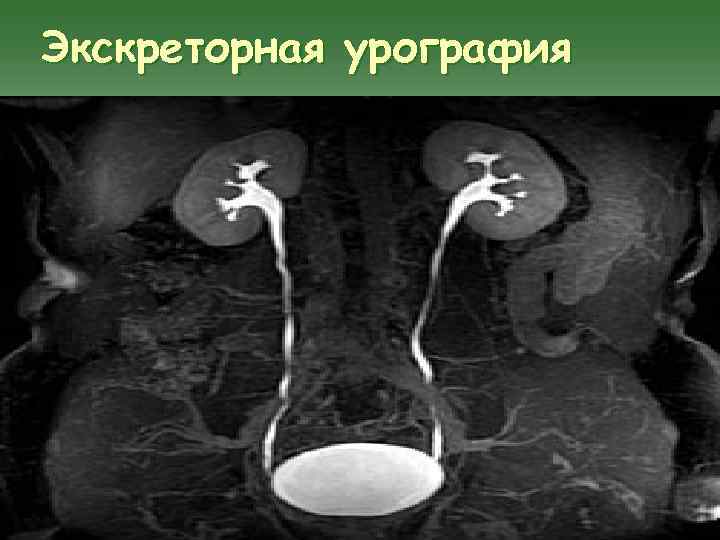 Экскреторная урография 