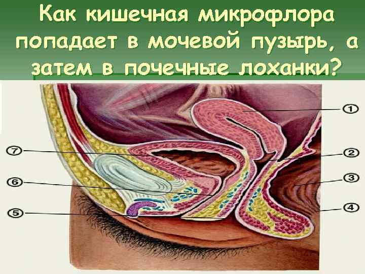 Как кишечная микрофлора попадает в мочевой пузырь, а затем в почечные лоханки? 