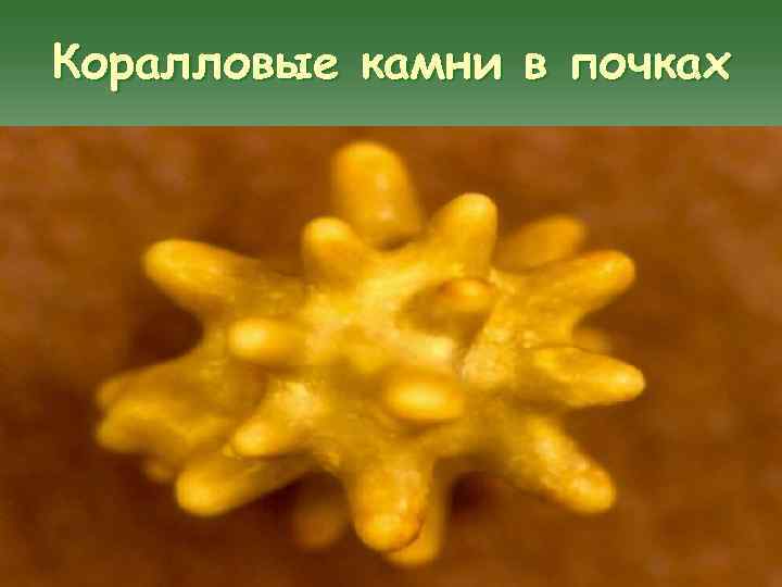 Коралловые камни в почках 