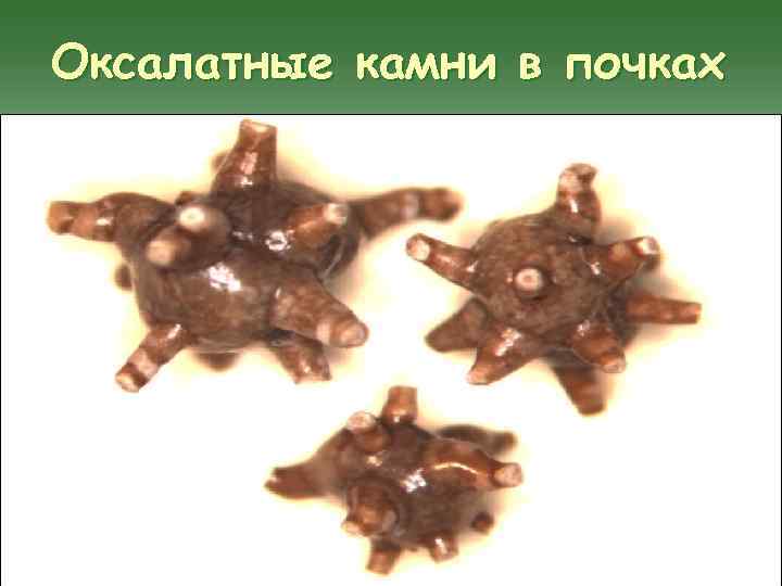 Оксалатные камни в почках 