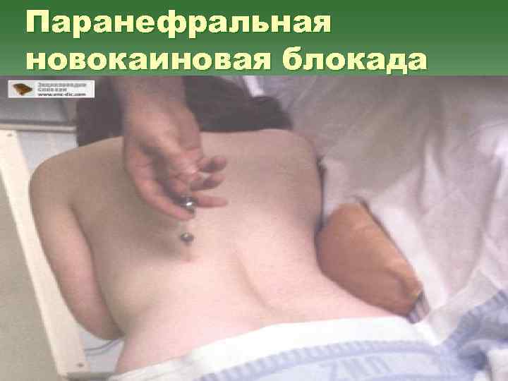 Паранефральная новокаиновая блокада 
