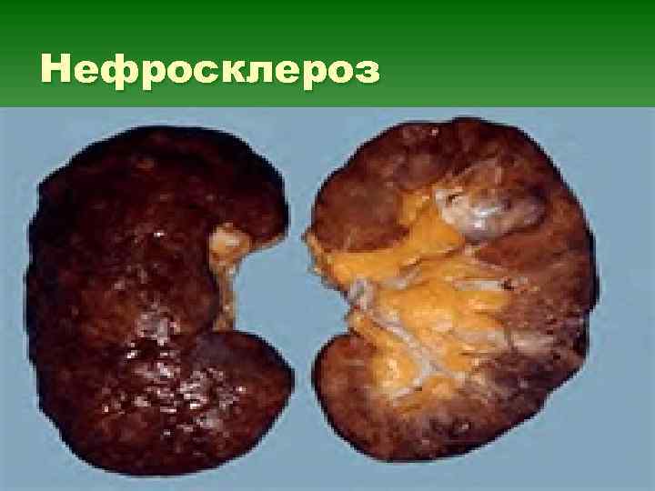 Нефросклероз 