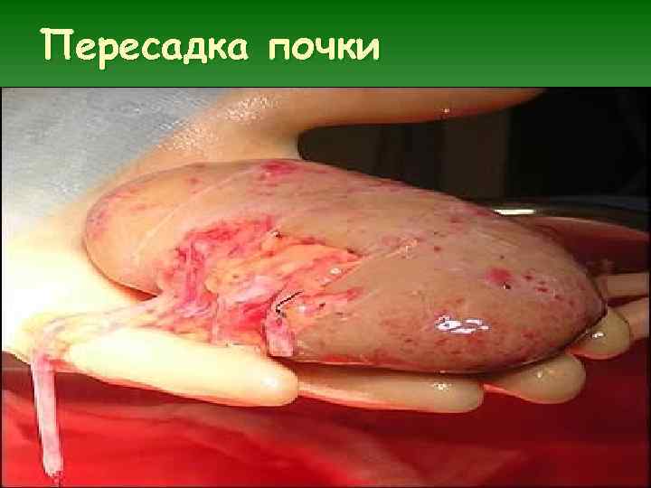 Пересадка почки 