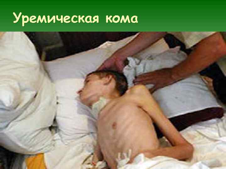 Уремическая кома 