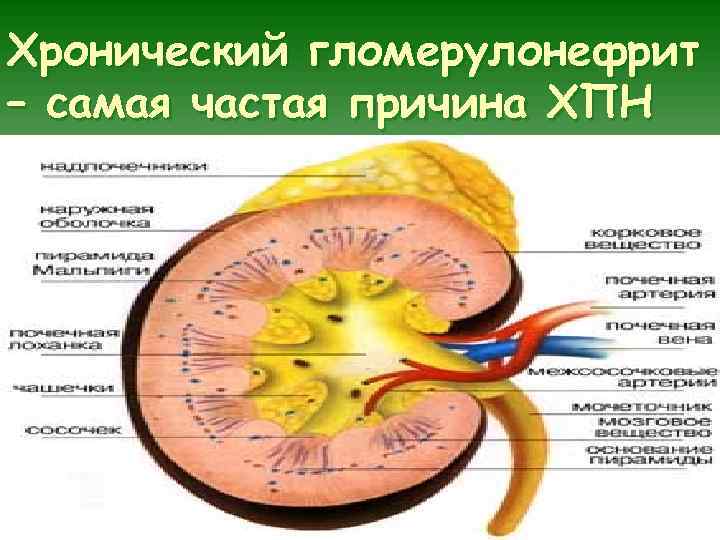 Хронический гломерулонефрит – самая частая причина ХПН 