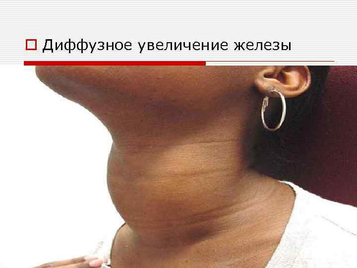 o Диффузное увеличение железы 