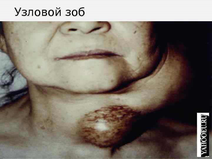 Узловой зоб 