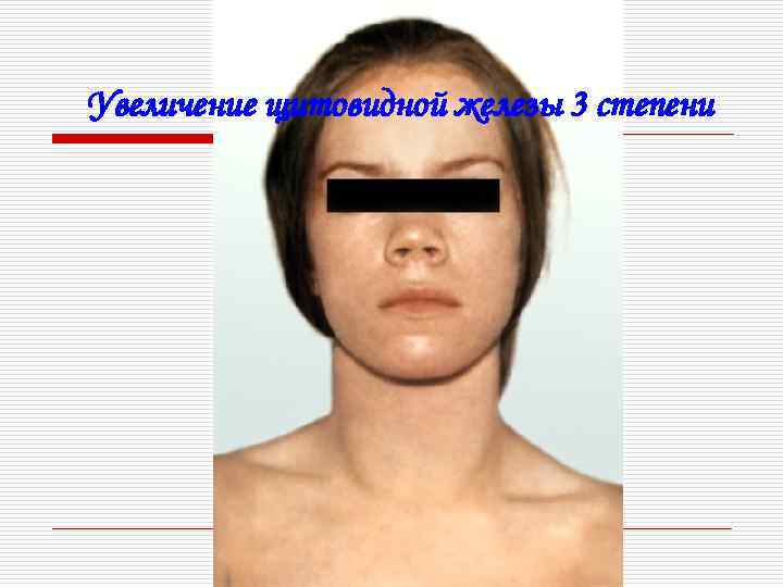 Увеличение щитовидной железы 3 степени 