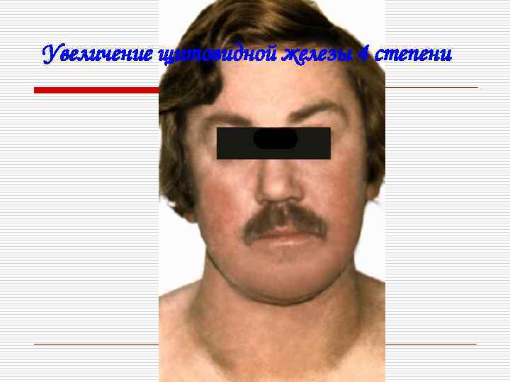 Увеличение щитовидной железы 4 степени 